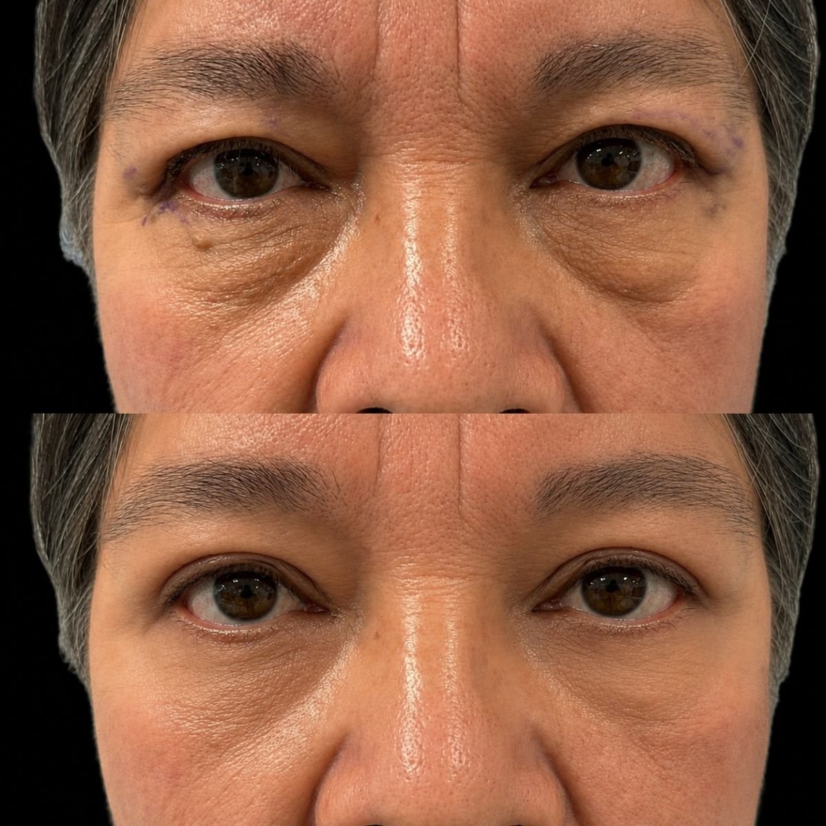 Résultats avant et après blépharoplastie chez Lucio Santos Plastic Surgery, correction des paupières