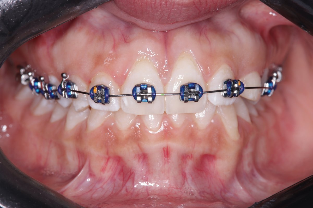 Braces treatment result – visible teeth alignment progress with metal brackets