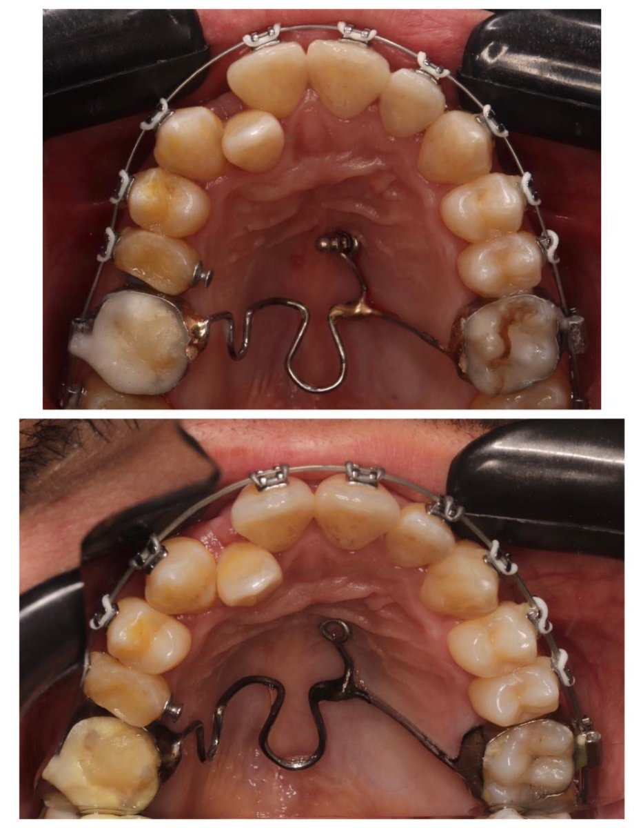 Before and after braces results – upper teeth alignment improvement with orthodontic treatment