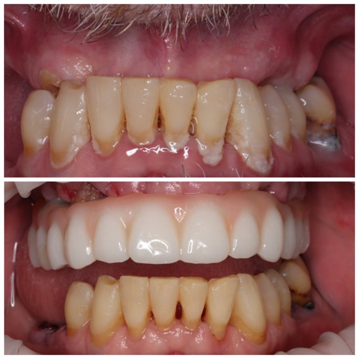 Before and after dental implant results – restored upper teeth and improved smile aesthetics
