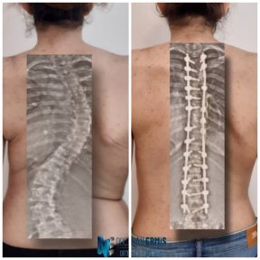 Scoliosis Surgery - photo 6