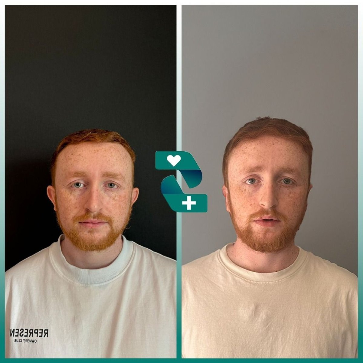 Before and after otoplasty results at Soraca Med, improved ear shape and symmetry