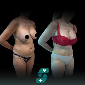 Premium Tummy-Tuck & 360 Liposaction Summer Packet All Included - photo 6