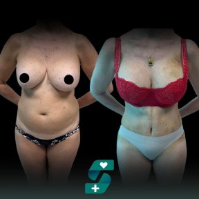 Premium Tummy-Tuck & 360 Liposaction Summer Packet All Included - photo 5