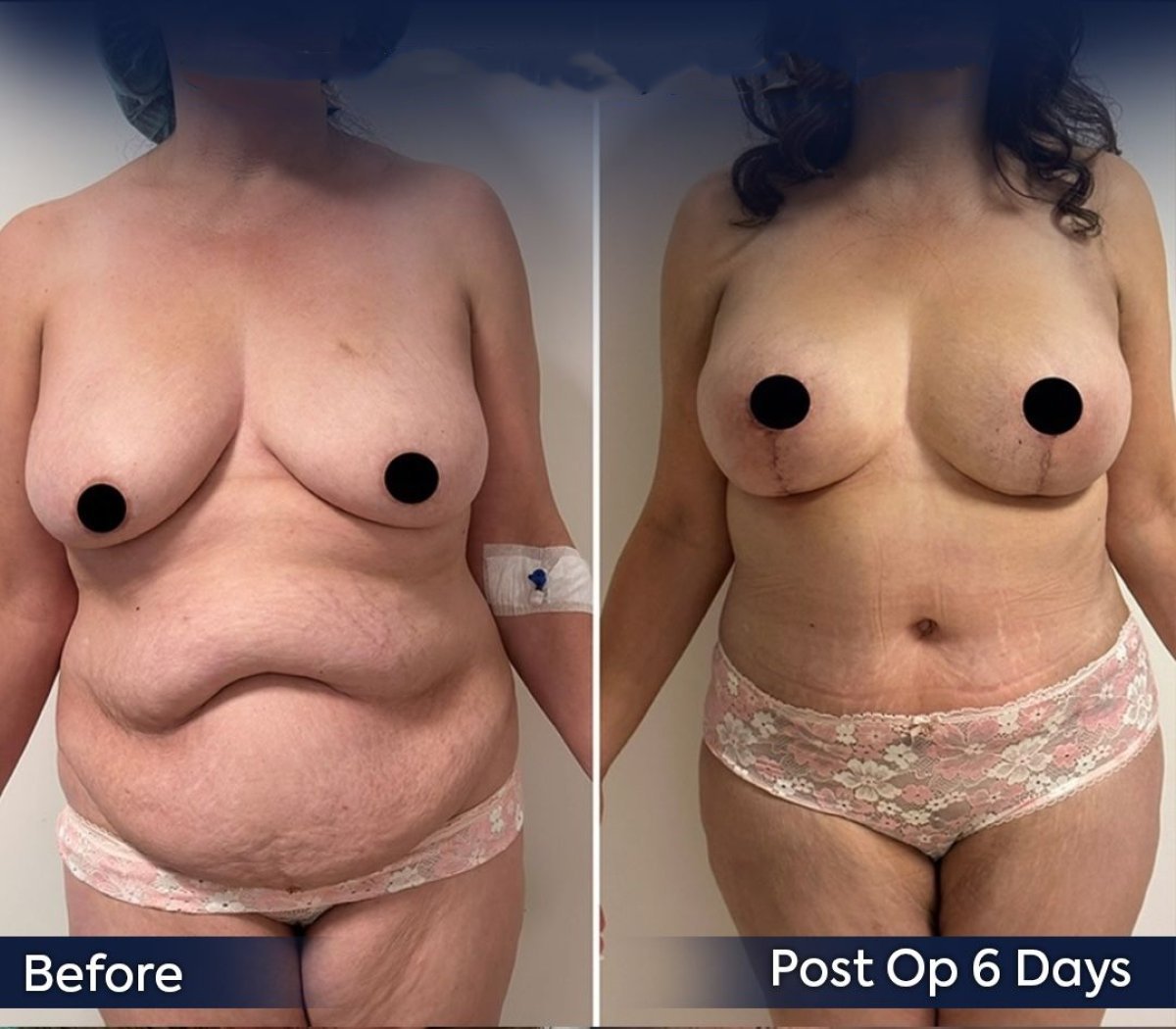 Resultados de lifting de senos y abdominoplastia antes y después en Dr. Safa Manav, 6 días