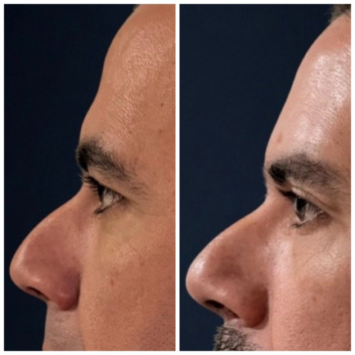 Resultados de rinoplastia antes y después en Dr. Michel Salameh - Plastic And Aesthetic Surgery