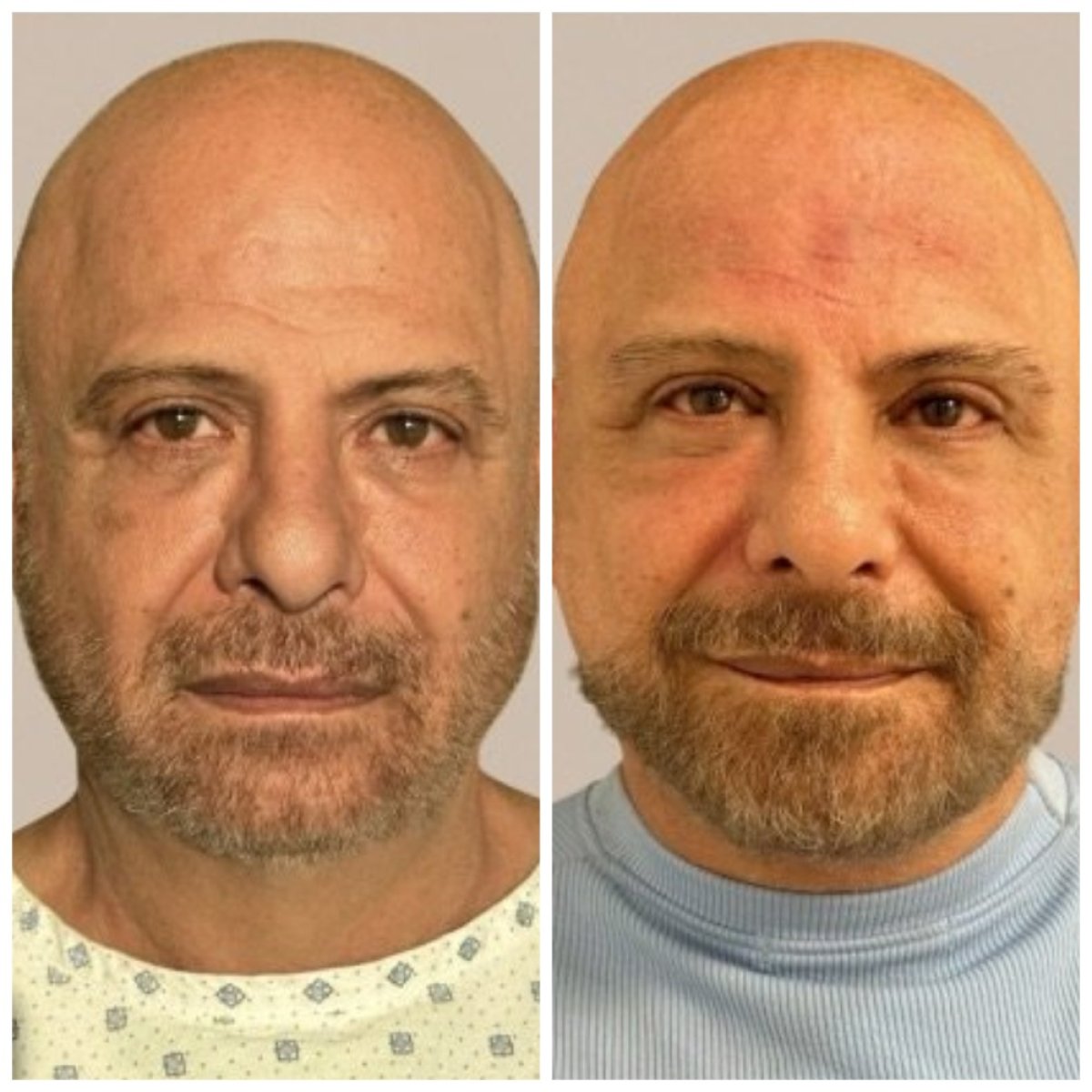 Resultados de blefaroplastia antes y después en Dr. Michel Salameh - Plastic And Aesthetic Surgery