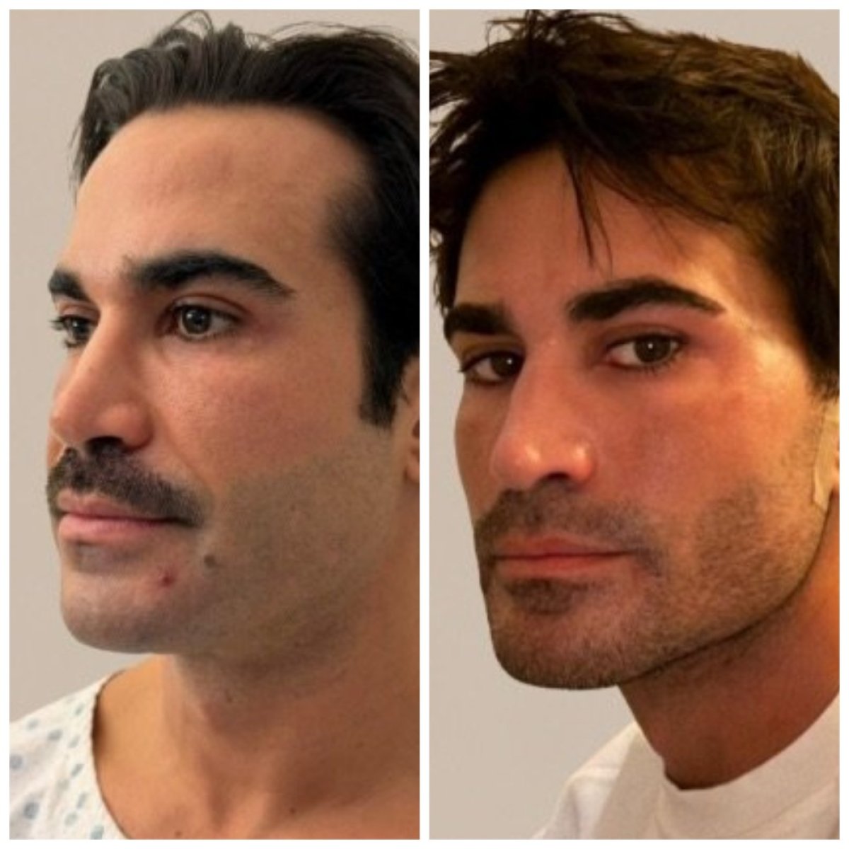 Resultados de blefaroplastia antes y después en Dr. Michel Salameh - Cirugía Plástica