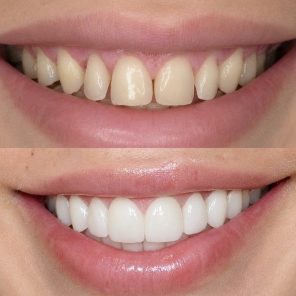 Before and after veneers result – smile transformation with whiter, even teeth