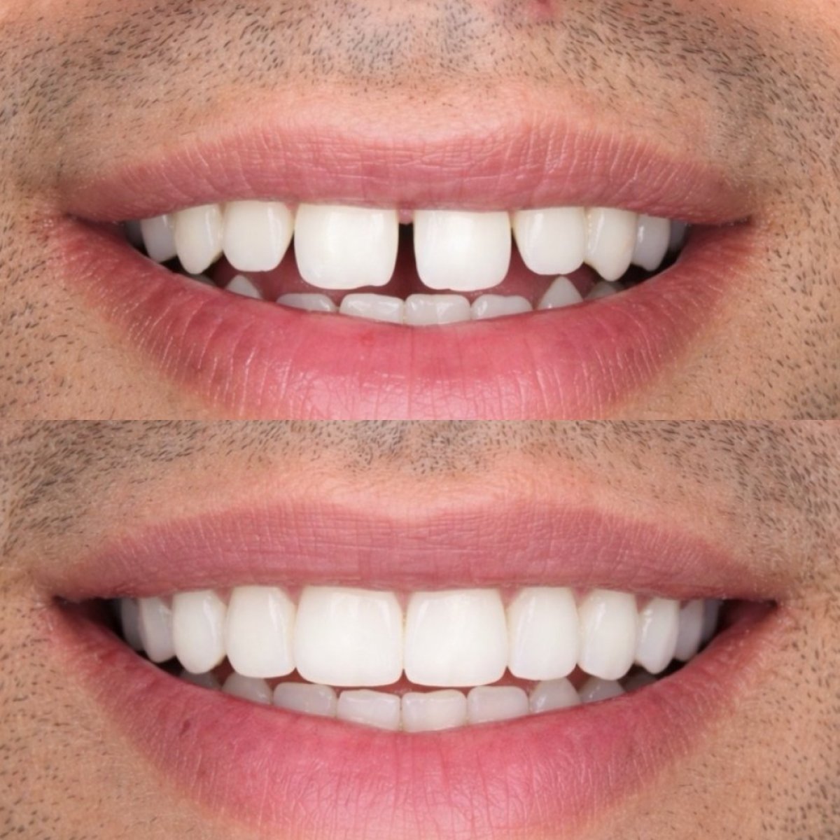 Before and after veneers procedure results – improved smile and aligned teeth transformation