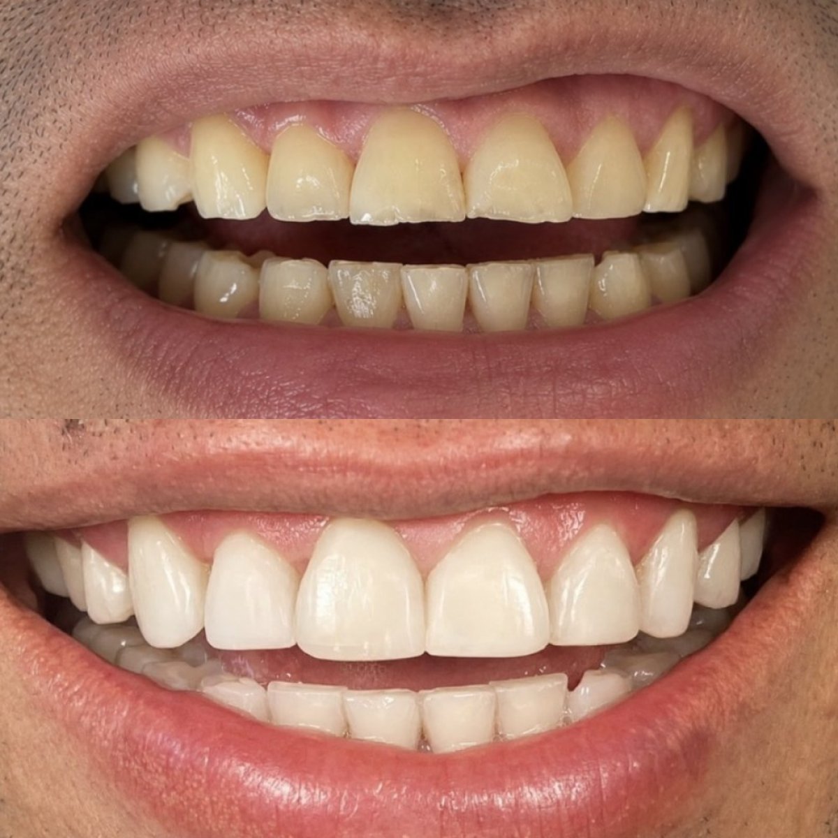 Before and after veneers results – improved smile aesthetics and whiter teeth transformation