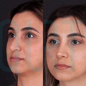 Premium Rhinoplasty (nose job) All Included - photo 6