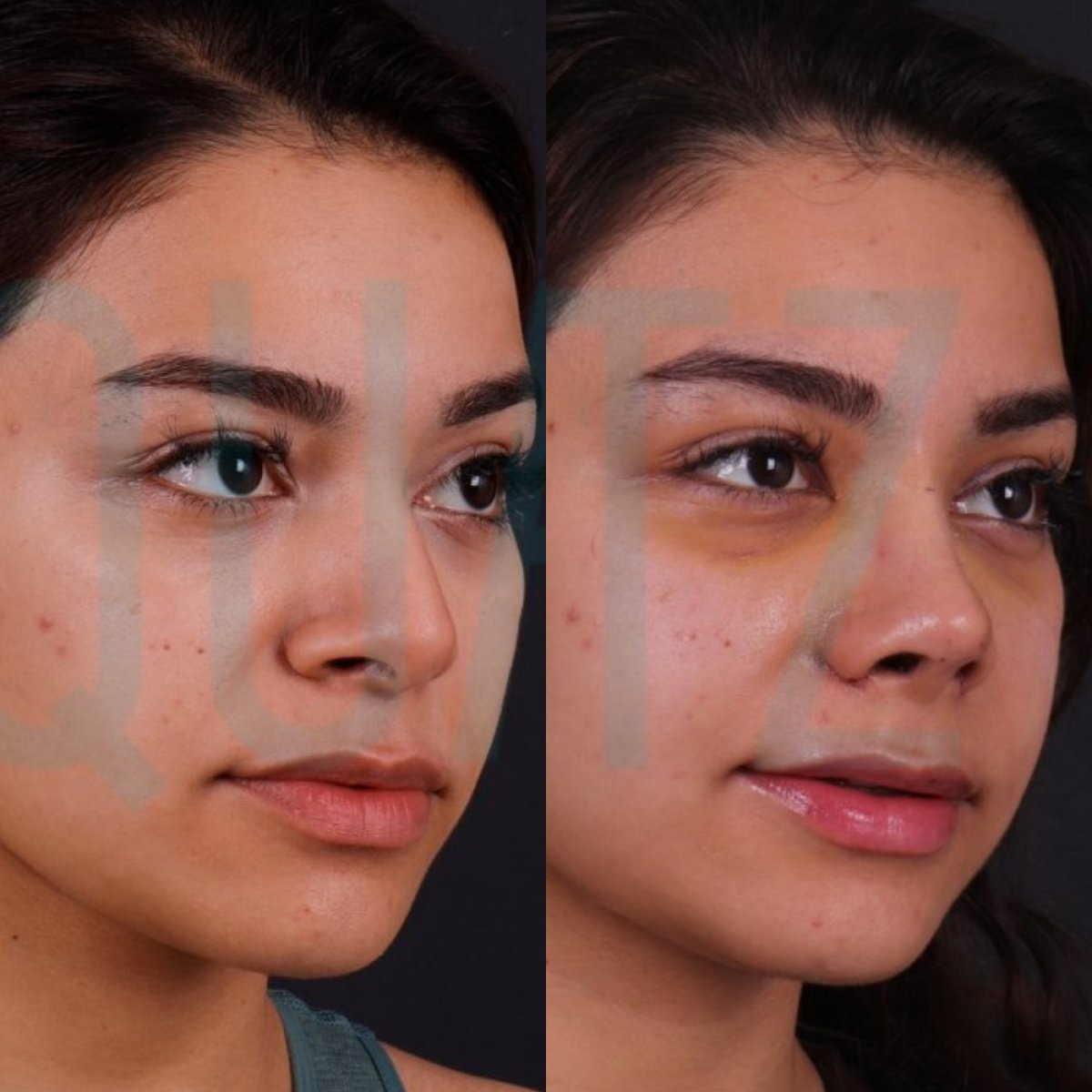 Before and after rhinoplasty results at Quartz Hospital, nose reshaping for improved profile