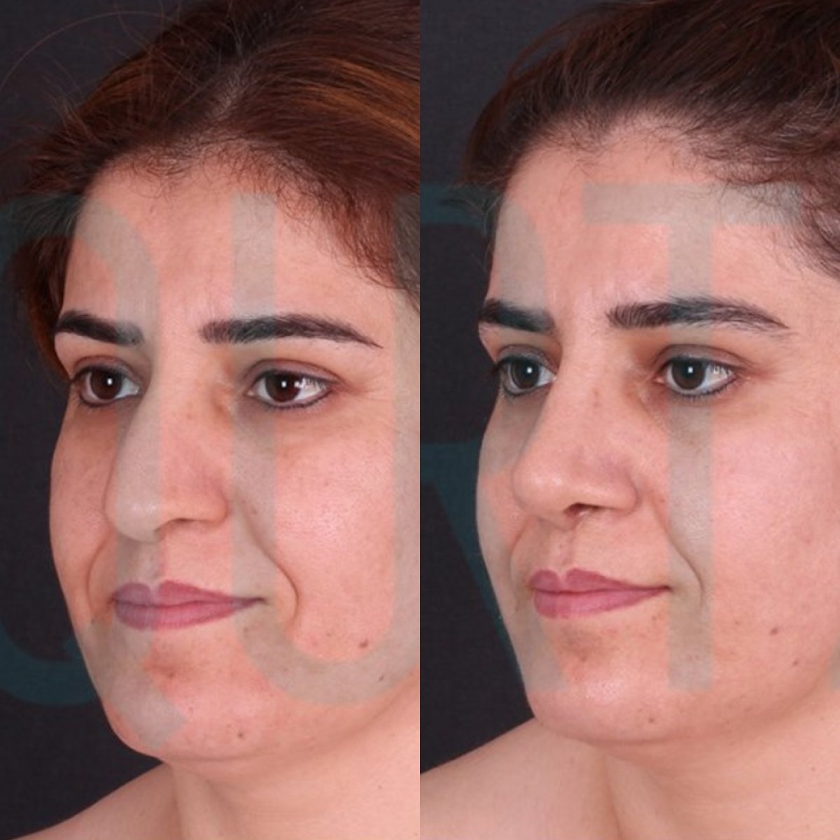Before and after rhinoplasty results at Quartz Hospital, improved nose shape and facial harmony