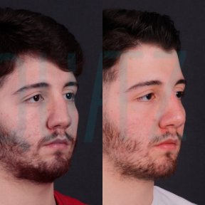 Premium Rhinoplasty (nose job) All Included - photo 4