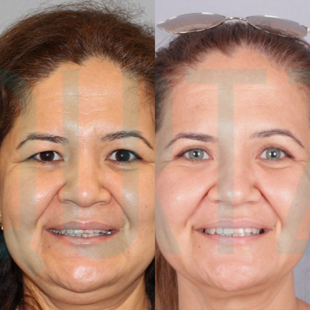 Before and after Deep Plane Facelift results at Quartz Hospital – facial rejuvenation visible