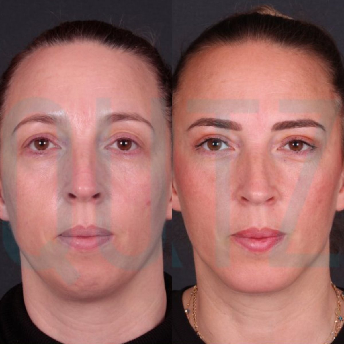 Resultados antes y después de Deep Plane Facelift en Quartz Hospital, rejuvenecimiento facial visible