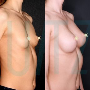 Premium Breast Implants with Breast Lift All Included - photo 6