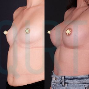 Premium Breast Implants with Breast Lift All Included - photo 5