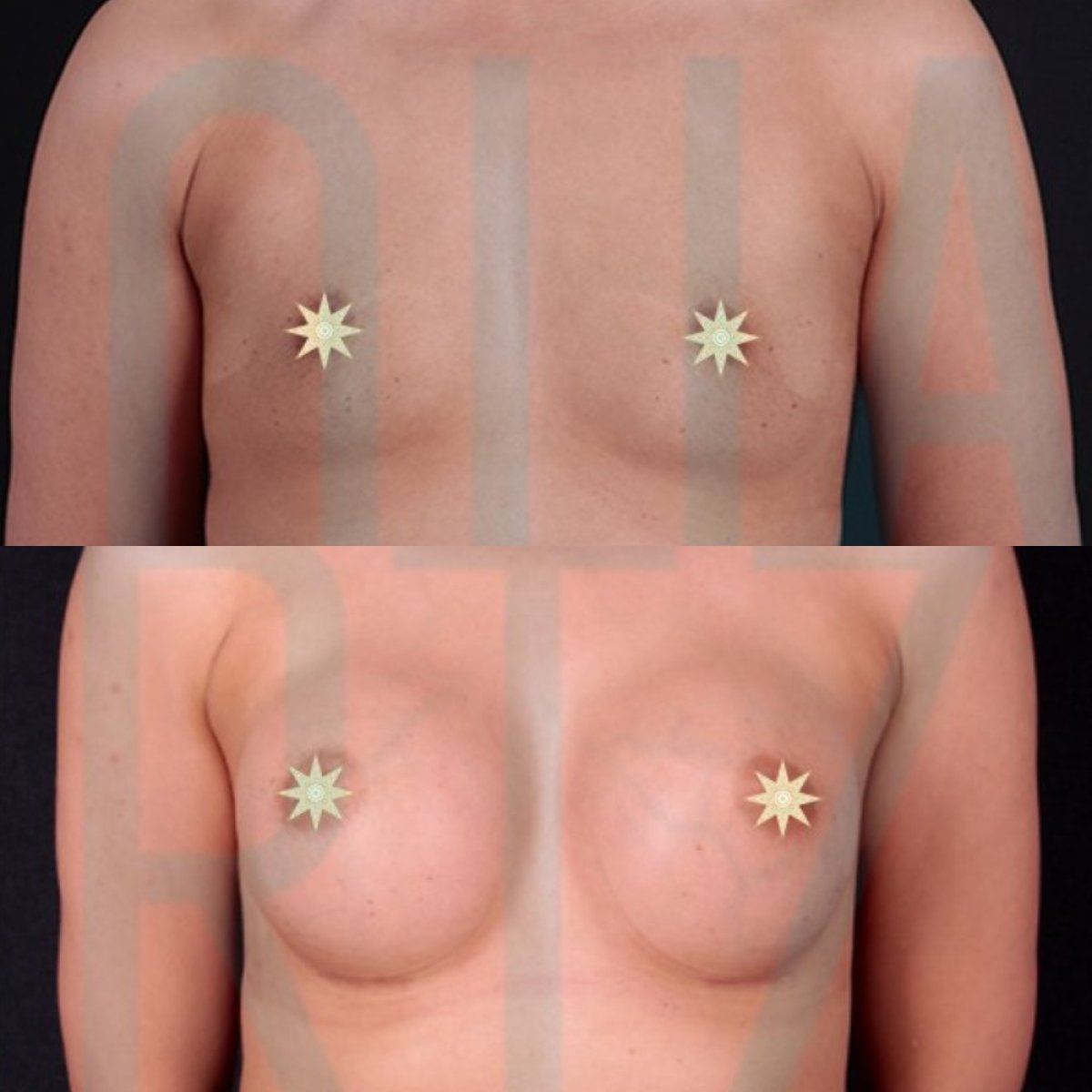 Before and after breast implants with lift at Quartz Hospital – enhanced breast shape result