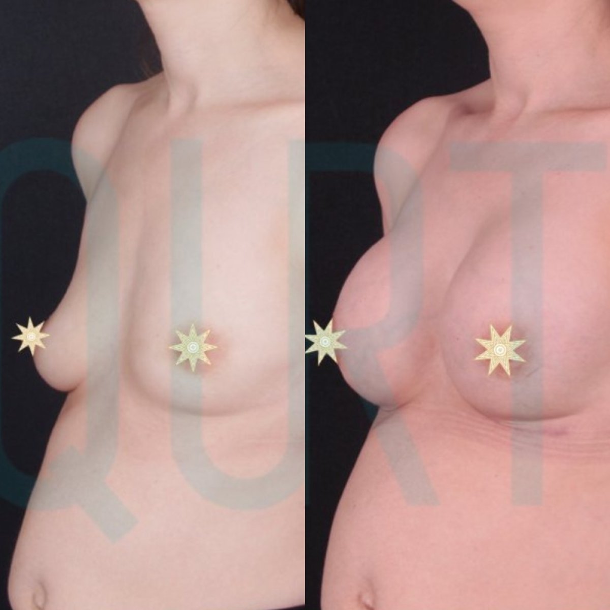 Before and after breast implants with lift at Quartz Hospital, enhanced breast shape result