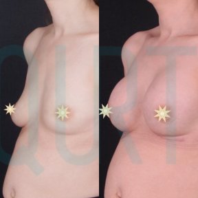 Premium Breast Implants with Breast Lift All Included - photo 6