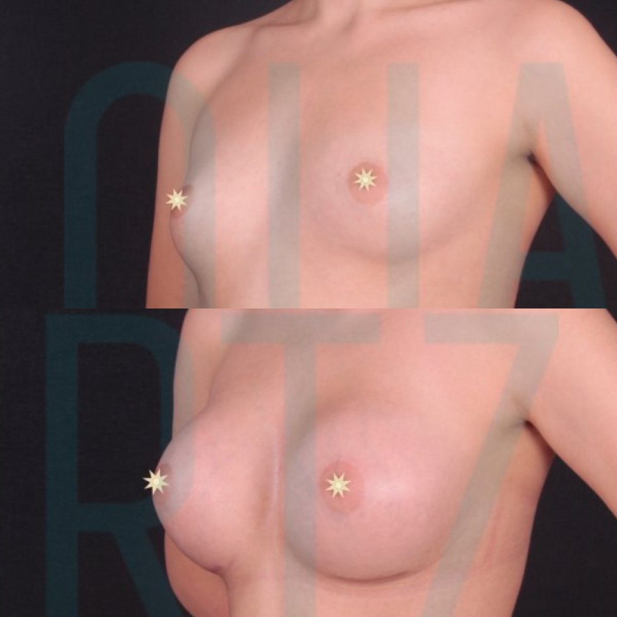 Avant/après implants mammaires avec lifting à Quartz Hospital, résultat forme améliorée