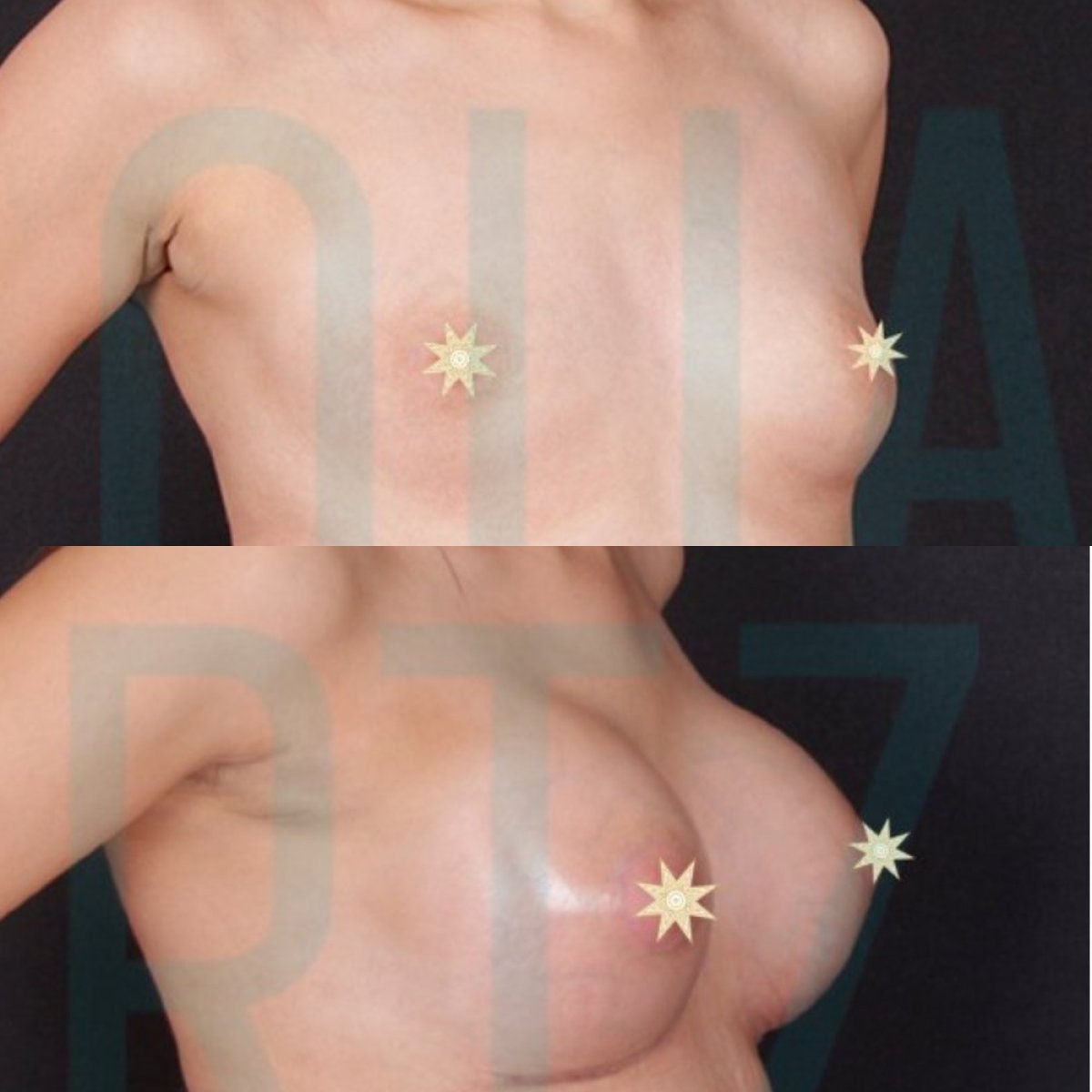 Before and after breast implants with lift at Quartz Hospital – enhanced breast shape result