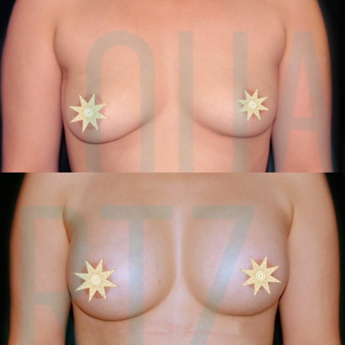 Before and after breast implants with lift at Quartz Hospital – enhanced breast shape result