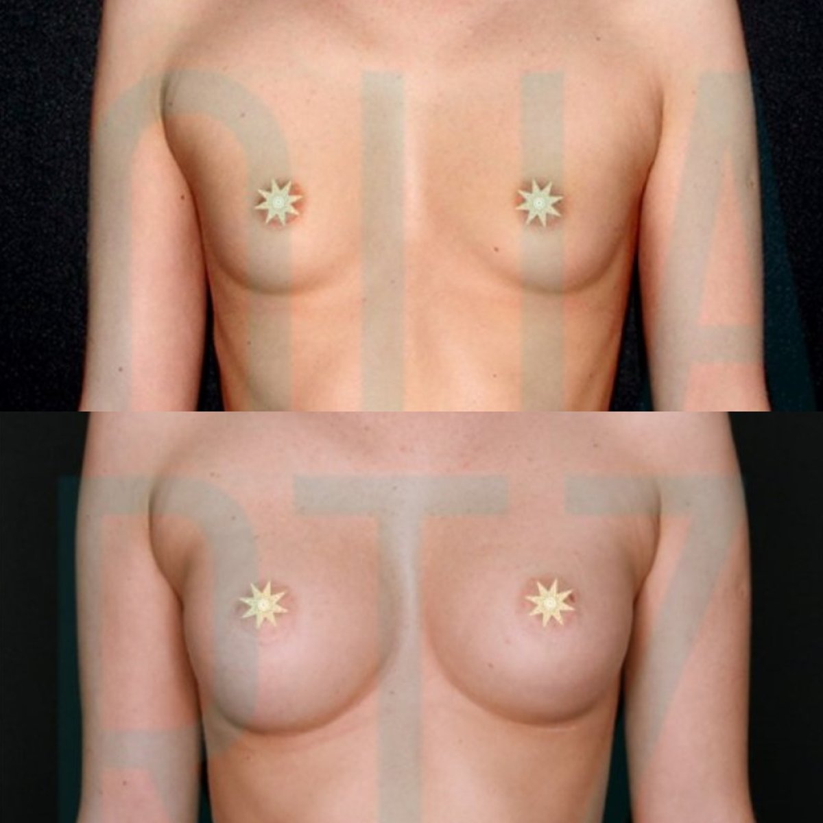 Before and after breast implants with lift at Quartz Hospital, enhanced breast shape result