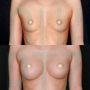 Premium Breast Implants with Breast Lift All Included - photo 4