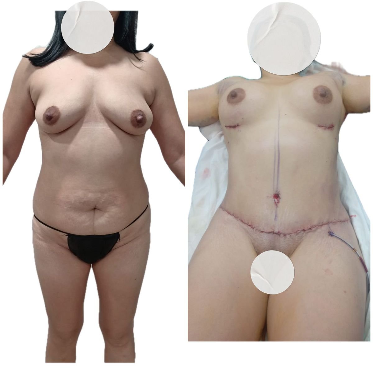 Resultados antes y después de mommy makeover en Hospital de la Familia, mejora del contorno corporal