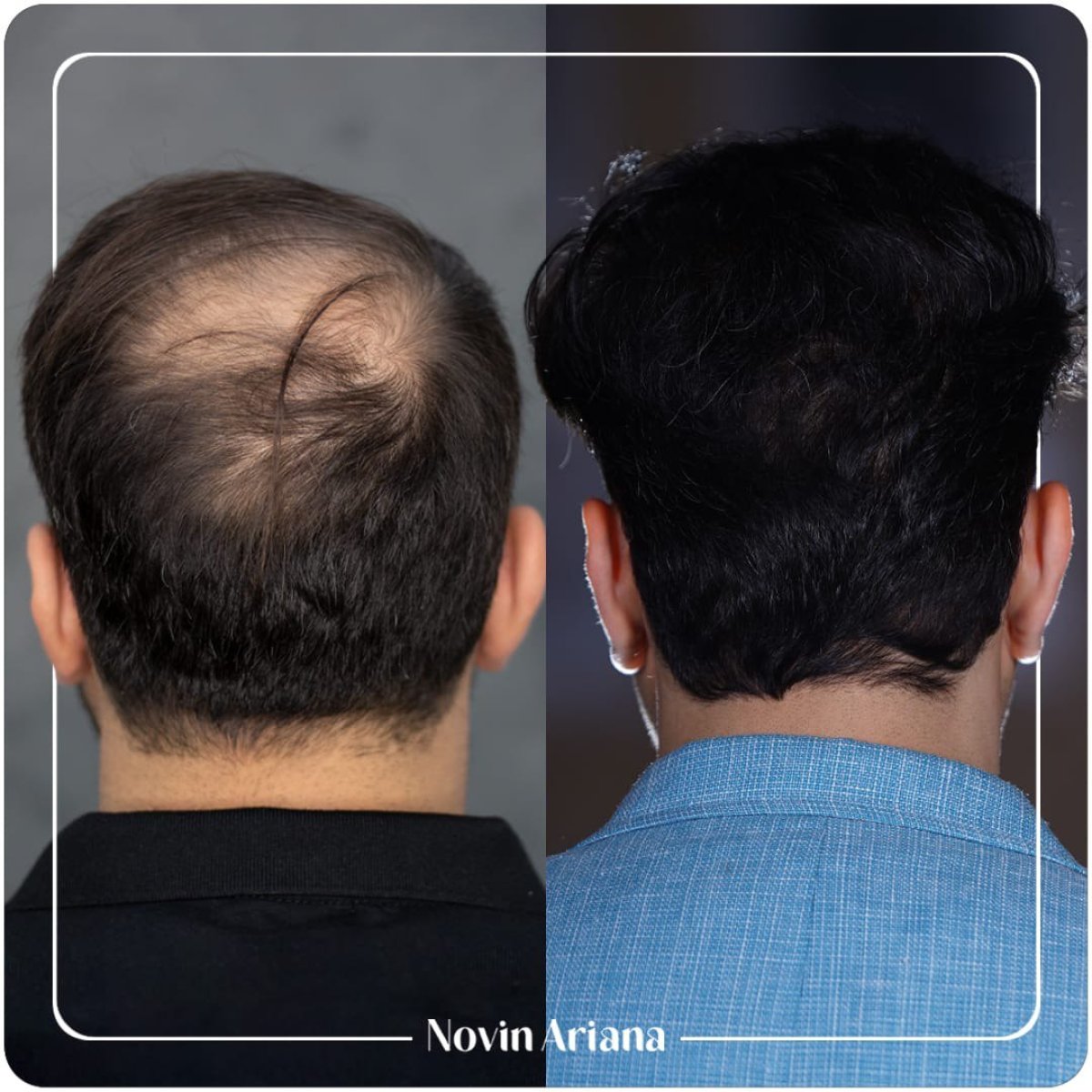 نتائج زراعة الشعر قبل وبعد في عيادة Novin Ariana – استعادة كثافة الشعر