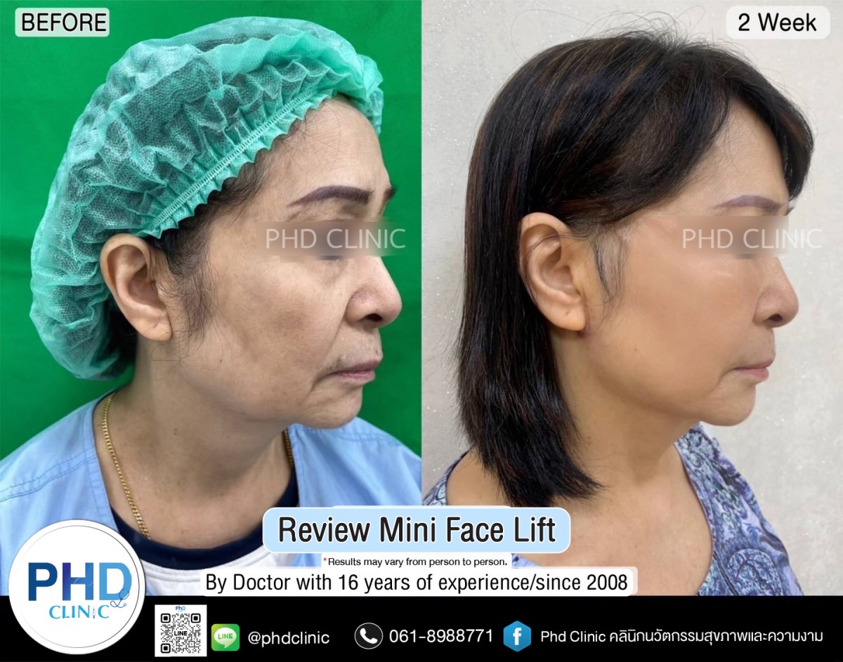 Before and after mini facelift results at PHD Clinic – visible facial rejuvenation after 2 weeks