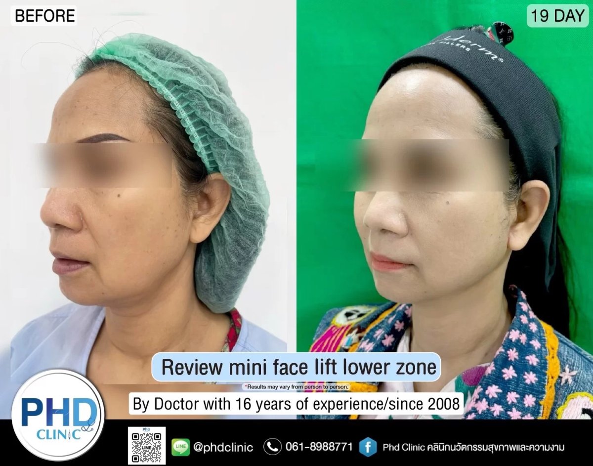 Before and after mini facelift results at PHD Clinic – improved lower face contour