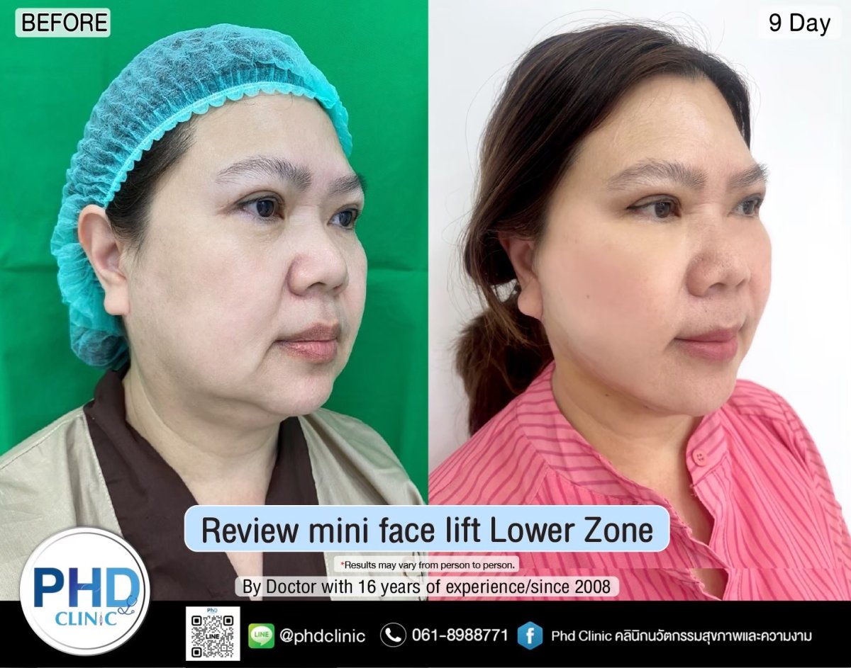 Before and after mini facelift lower zone results at PHD Clinic, visible facial contour lift