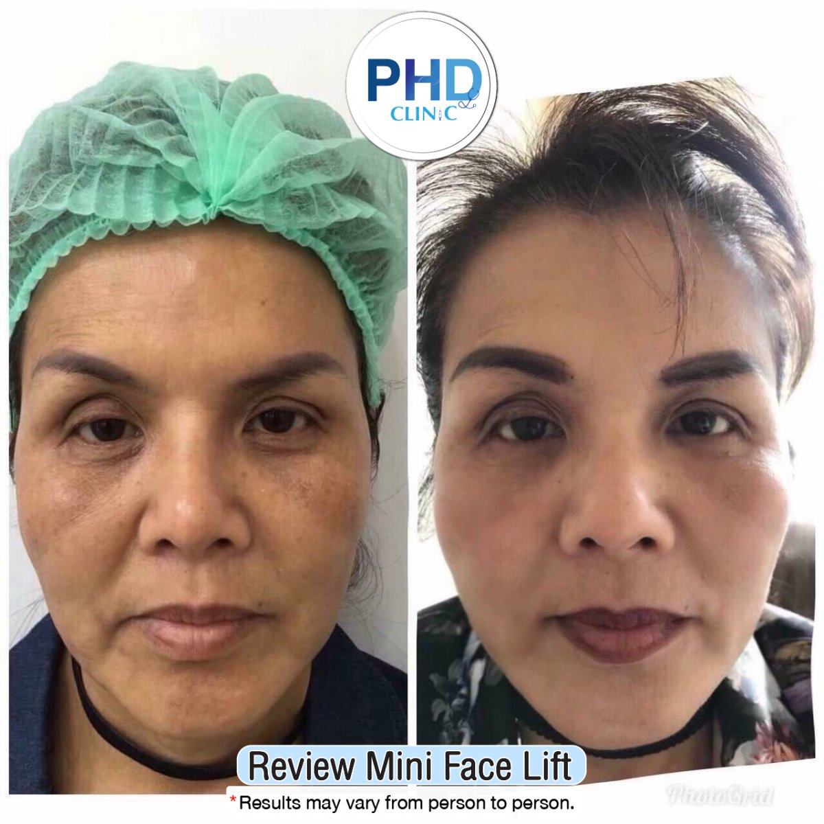 Resultados de minilifting facial antes y después en PHD Clinic – rejuvenecimiento visible