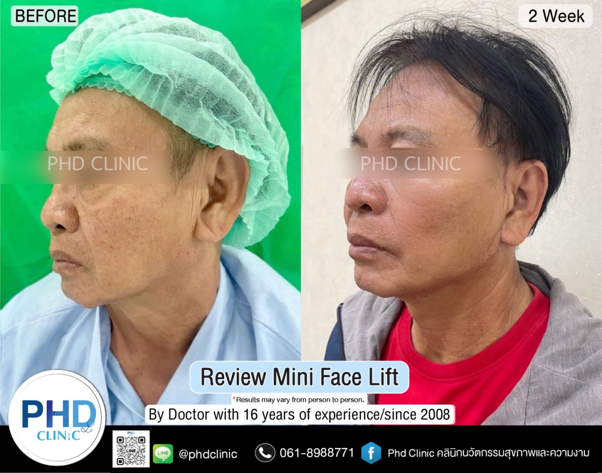 Resultados de mini lifting facial en PHD Clinic, rejuvenecimiento visible tras 2 semanas