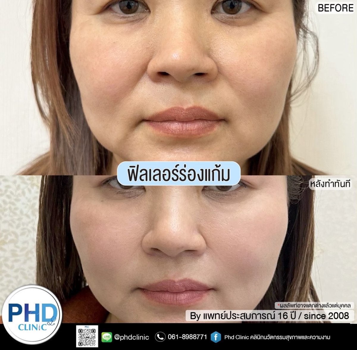 Результаты до и после инъекций филлеров носогубных складок в PHD Clinic, уменьшение морщин