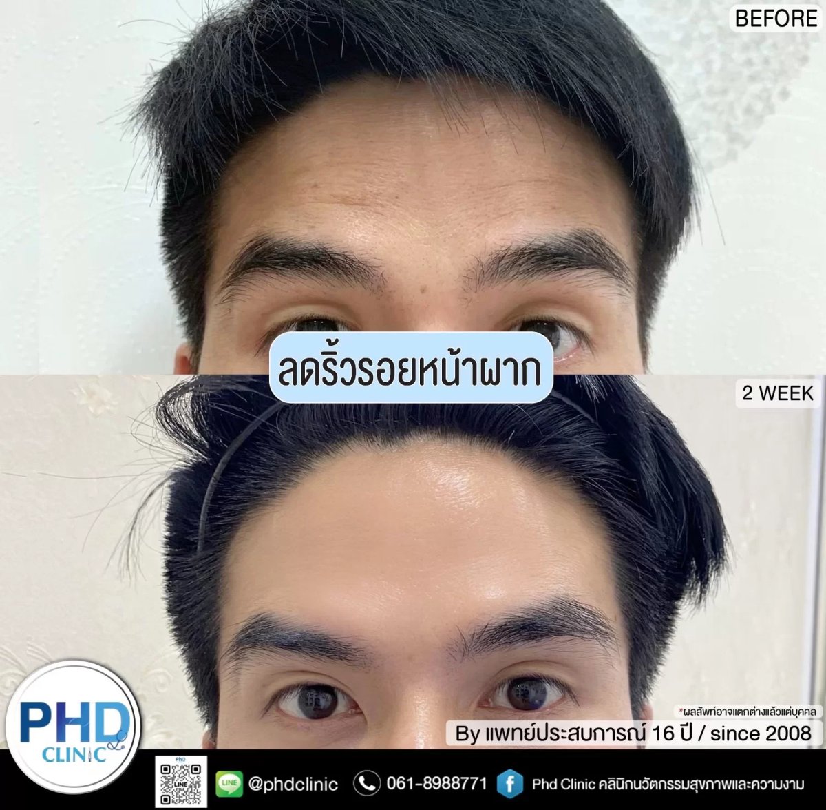 Forehead wrinkle reduction results 2 weeks after anti-wrinkle injectables at PHD Clinic