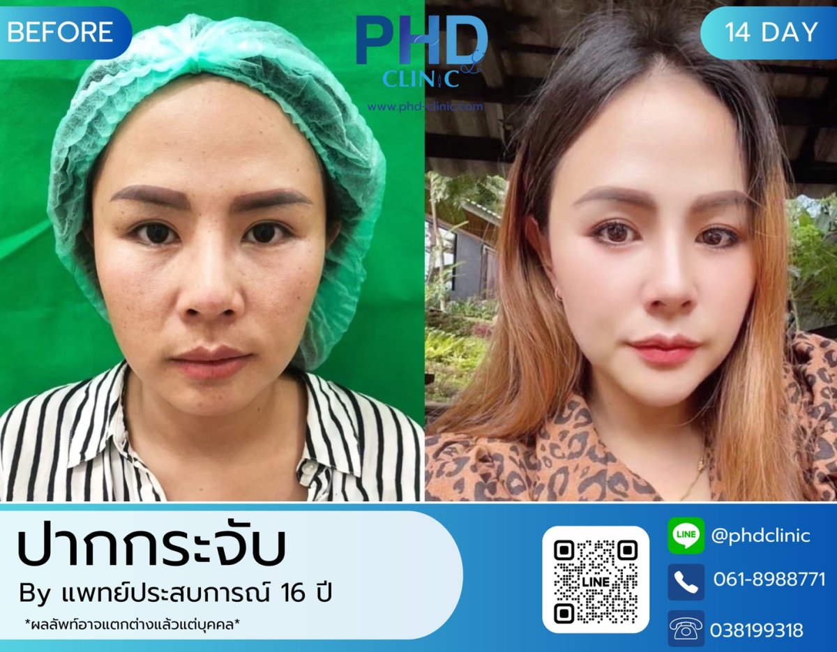 Antes y después de aumento de labios en PHD Clinic, labios más llenos tras 14 días
