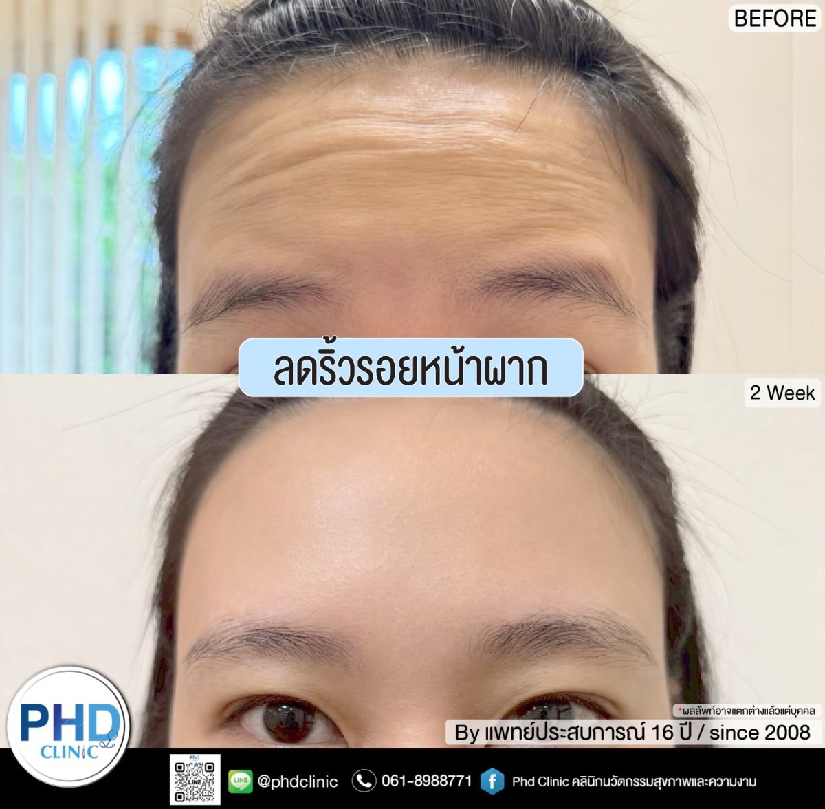 Уменьшение морщин на лбу инъекциями в PHD Clinic, результат через 2 недели