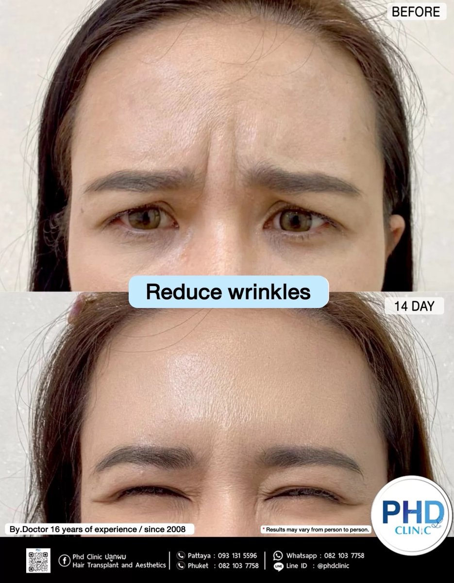 Before and after anti-wrinkle injectables result at PHD Clinic, smoother forehead in 14 days