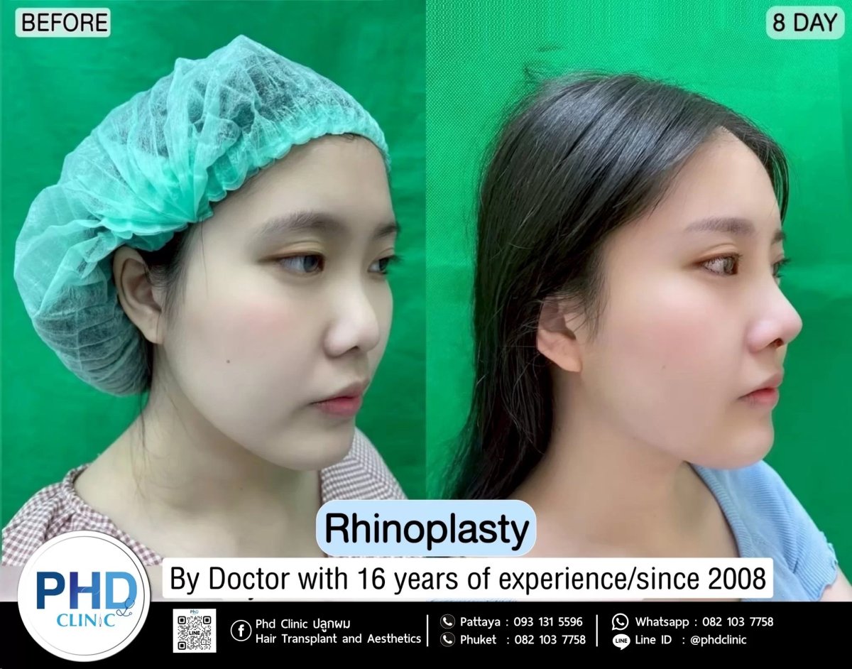 Результат ринопластики до и после в PHD Clinic, видимая коррекция носа через 8 дней