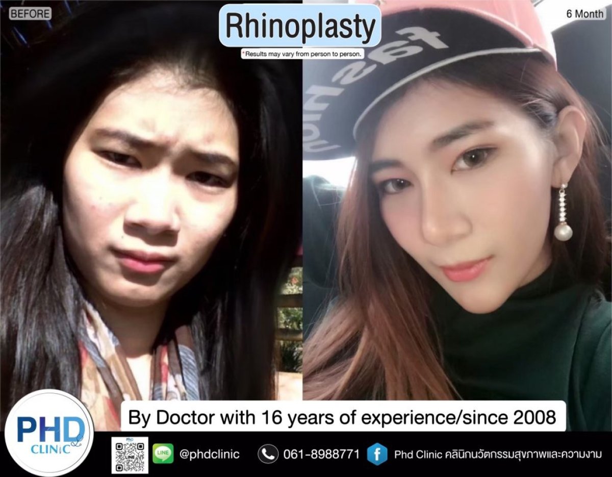 نتائج عملية تجميل الأنف قبل وبعد في عيادة PHD، إعادة تشكيل الأنف بمظهر طبيعي