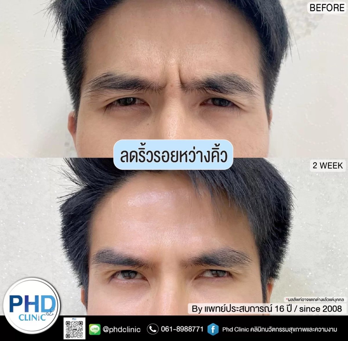 نتائج قبل وبعد حقن البوتوكس في عيادة PHD – تقليل خطوط العبوس بعد أسبوعين