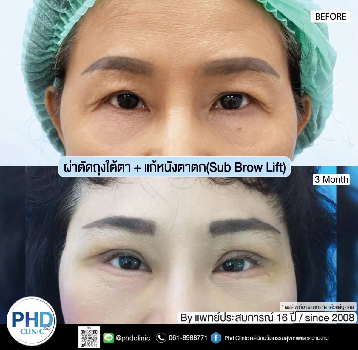 Результаты подтяжки бровей в PHD Clinic – улучшение век через 3 месяца