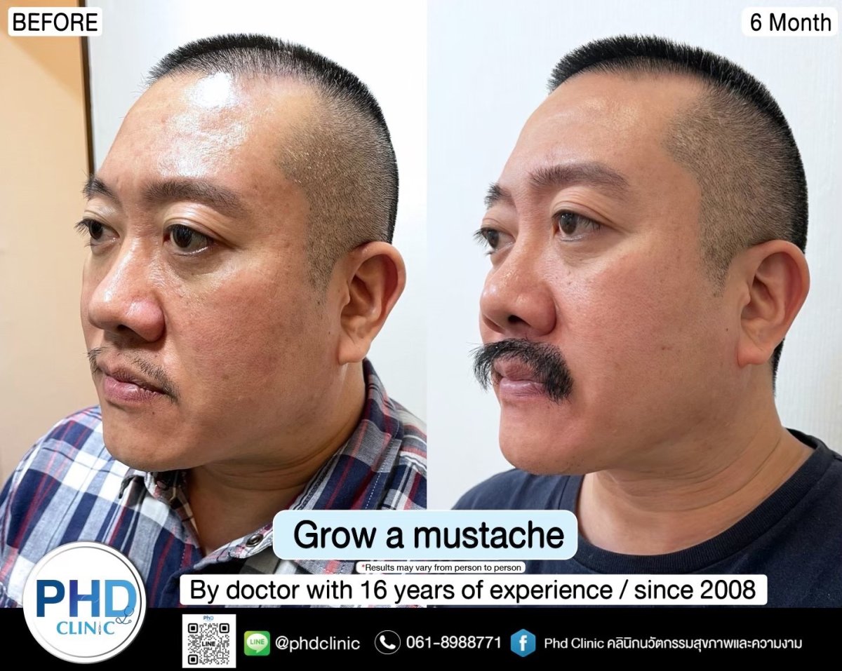 Before and after moustache transplant results at PHD Clinic, fuller facial hair in 6 months