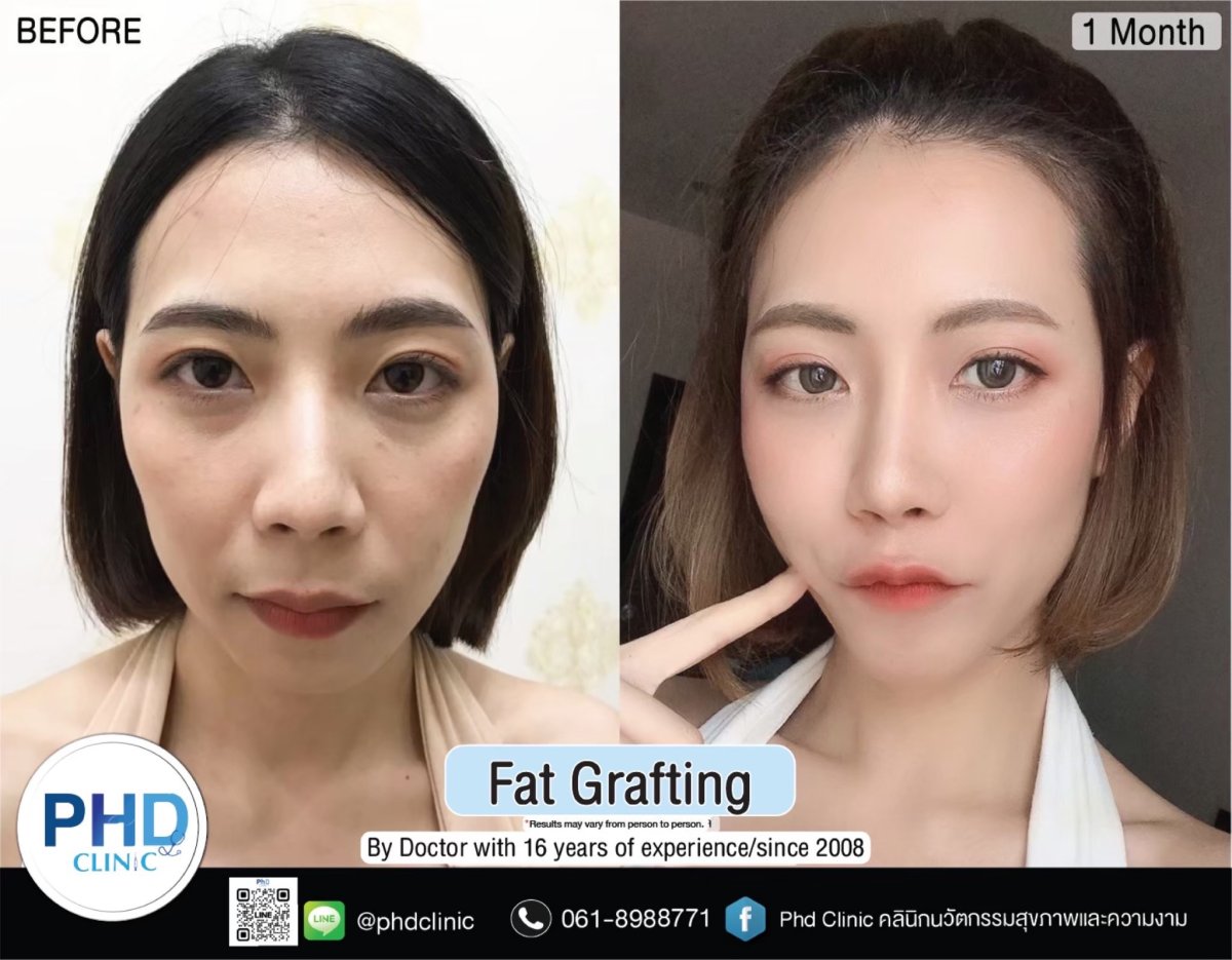 Résultats avant/après lipofilling visage à PHD Clinic – contours plus pleins et rajeunis