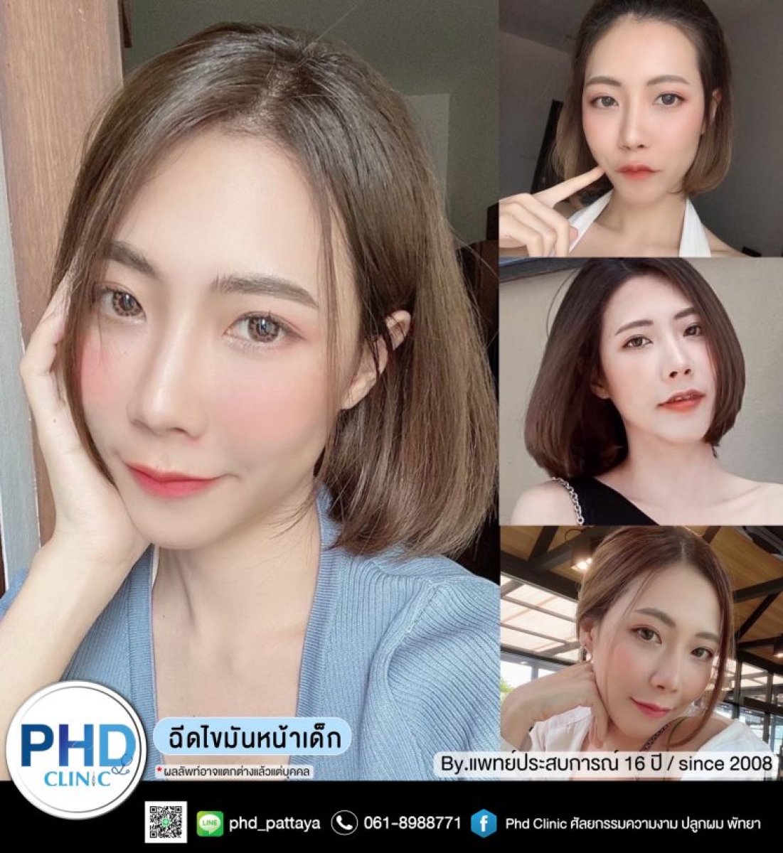 Результаты липофилинга лица до и после в PHD Clinic – омоложение контуров